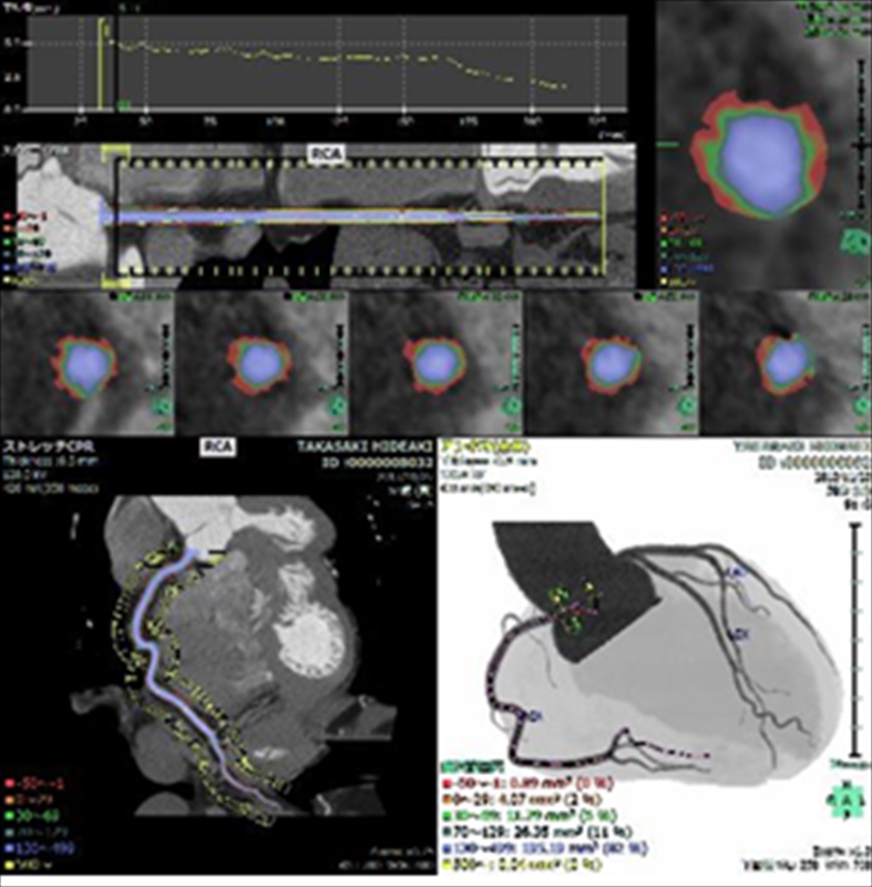 CT心臓解析_800