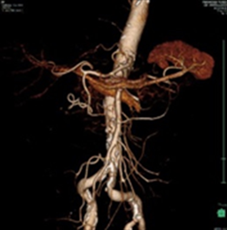 CT腹部血管_800