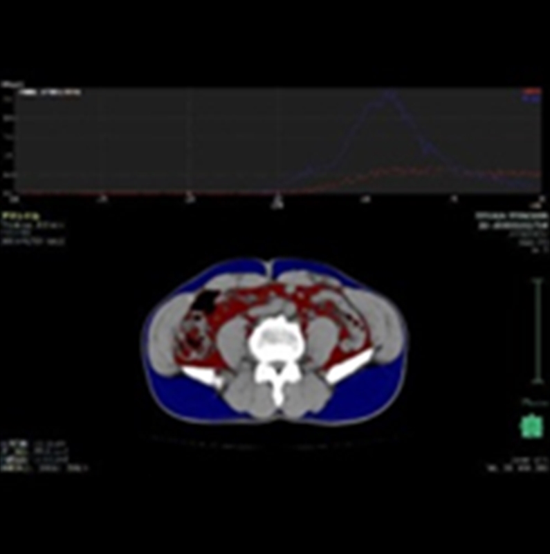 CT脂肪解析_800