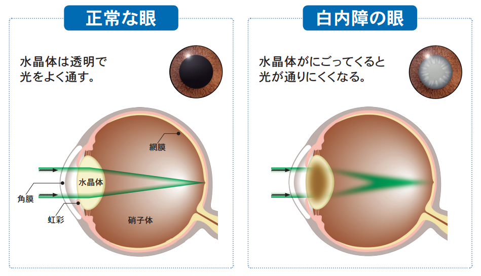 白内障手術について 神栖済生会病院